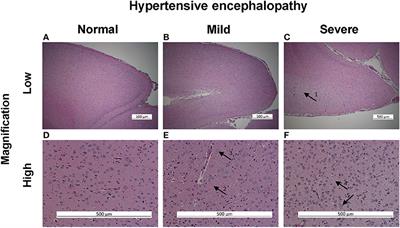 Circulating microRNAs May Serve as Biomarkers for Hypertensive Emergency End-Organ Injuries and Address Underlying Pathways in an Animal Model